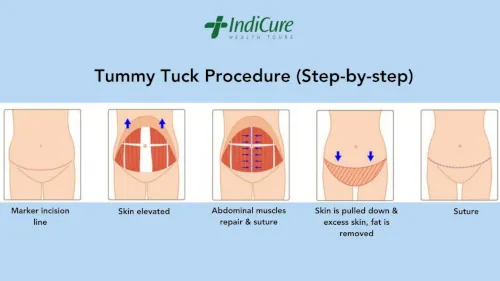 Tummy Tuck Procedure (Step-by-step)